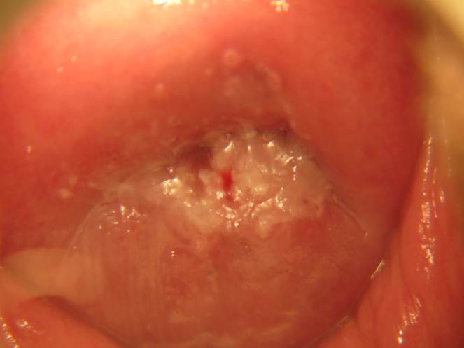 Fig. 5A. Cervicitis, before treatment. VIAC -, HIV-.