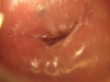 Fig. 1A. VIAC positive; Before treatment