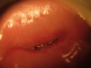 Fig. 1B. VIAC positive; 6 weeks after cryotherapy treatment