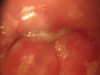 Fig. 2B. VIAC+, HIV+; After treatment