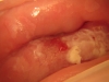 Fig. 2A. VIAC+, HIV+; Before treatment