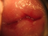 Fig. 3B. VIAC+, low CD4 count; After treatment