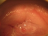 Fig. 4B. Cervicitis, after treatment. VIAC-, HIV-.