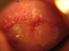 Fig. 4A. Cervicitis, before treatment. VIAC-, HIV-