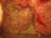 Fig. 9. Suspicious of cancer - HIV+