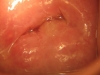 Fig. 5B. Cervicitis, after treatment. VIAC -, HIV -
