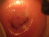 Fig. 6B. VIAC+, HIV-; After treatment