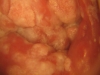 Fig. 7A. VIAC+, genital warts