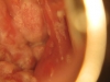 Fig. 7B. VIAC+, genital warts